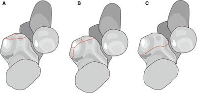 Classification of coronoid process fractures: A pending question